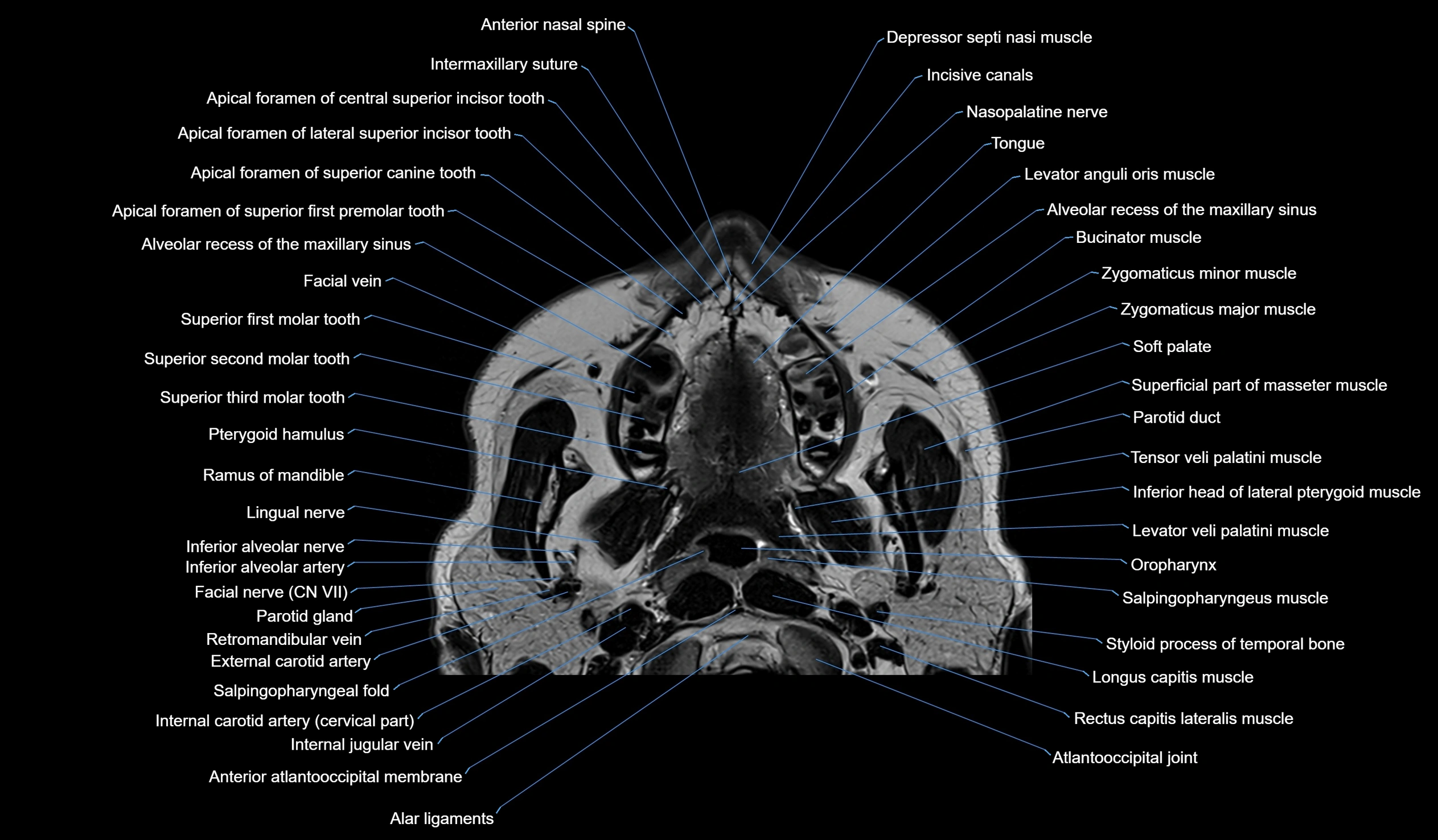 MRI face & paranasal sinuses(PNS) labelled  axial  cross sectional anatomy 3T radiology  image -00004.webp